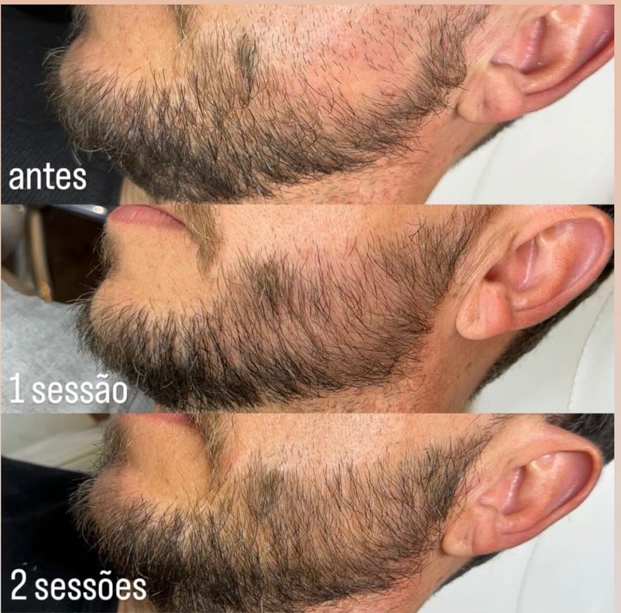 Resultado de paciente: ExoBarba · 2 sessões