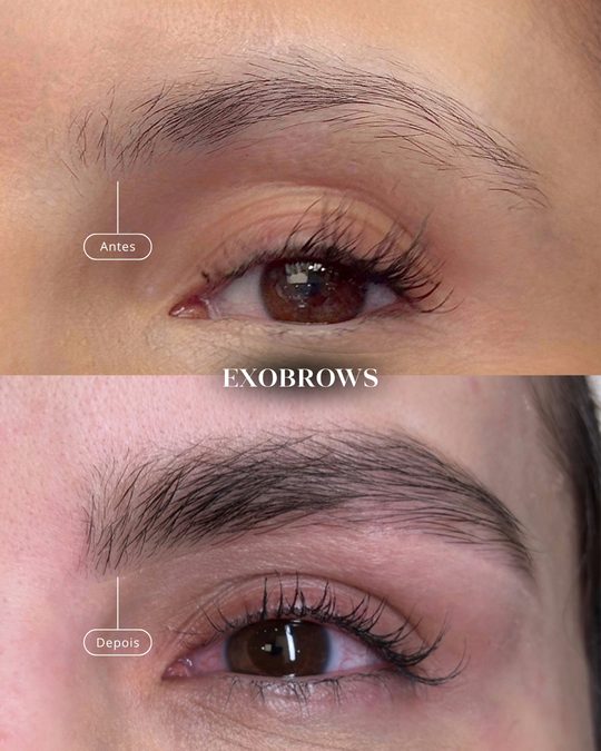 Resultado de paciente: ExoBrow · antes e depois