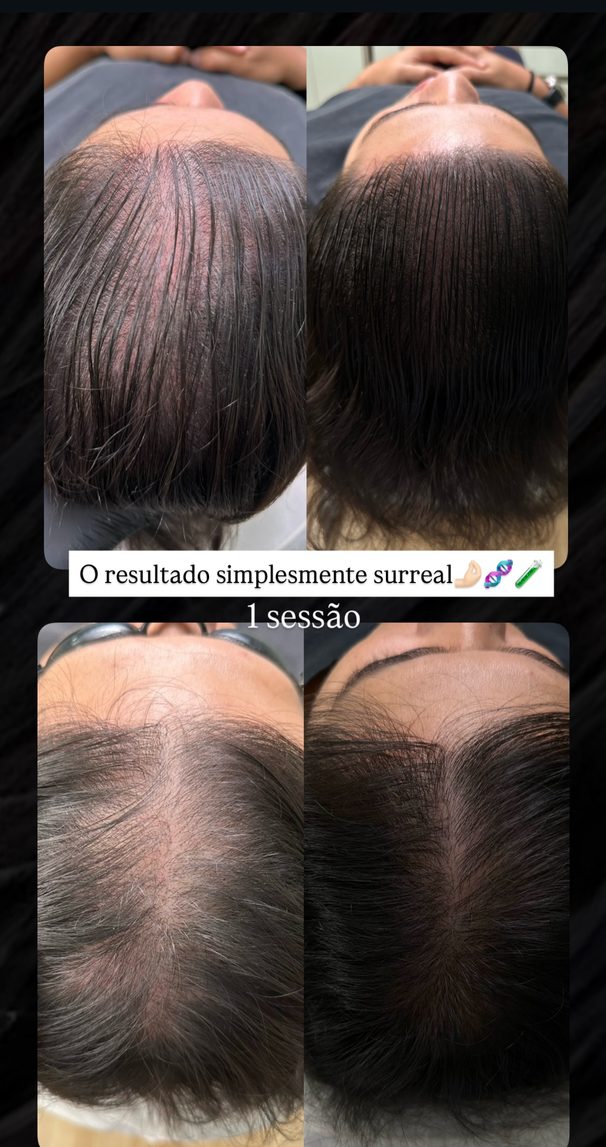 Resultado de paciente: ExoHair · 1 sessão